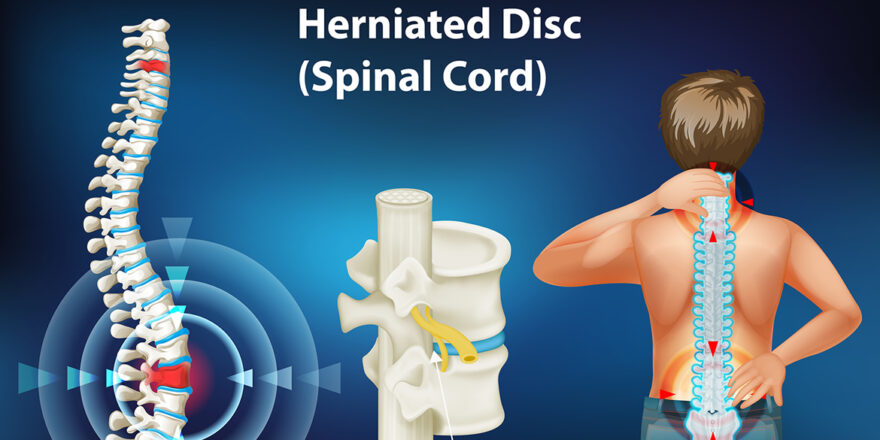 Non-surgical way to deal with spine disc pain