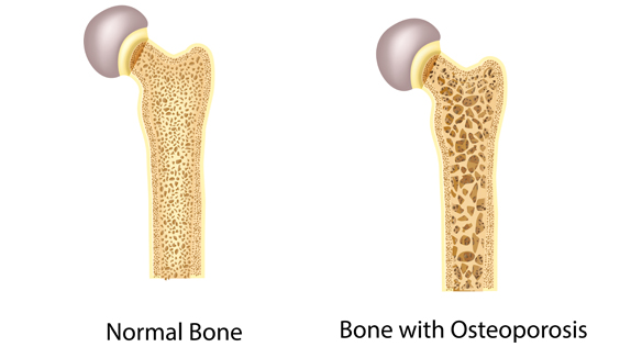 Osteoporosis: Risk factors, prevention & treatment II कमजोर हड्डियाँ: रोकथाम और उपचारI